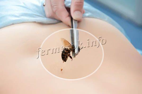 Лечение пчелиным ядом называют апитерапией